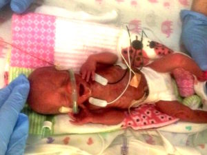 Amelée (1 lb 6 oz) right after being born on Valentine's Day.